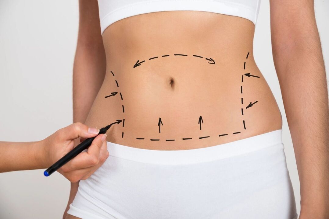 Mark the abdominal area before liposuction, shape correction. 